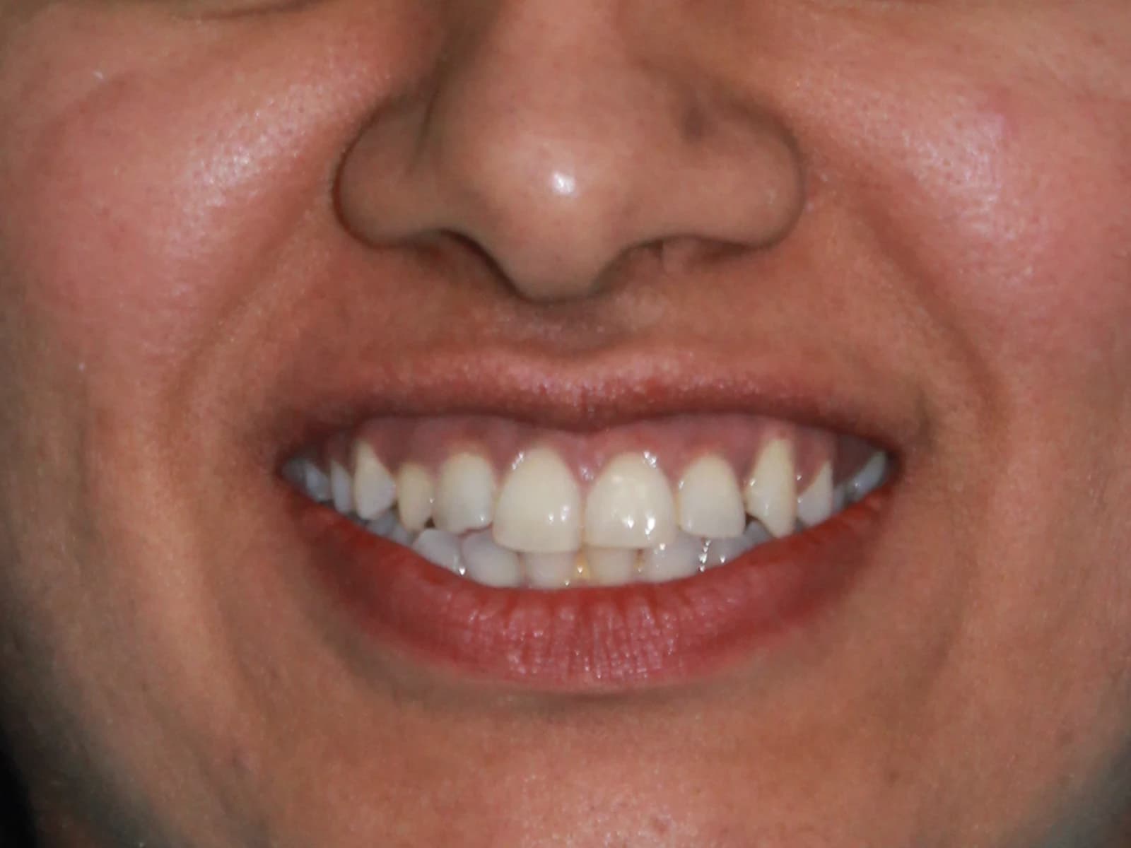 Misalignment — Before