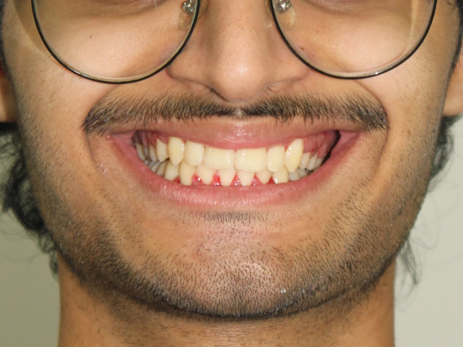 Orthodontic treatment — After