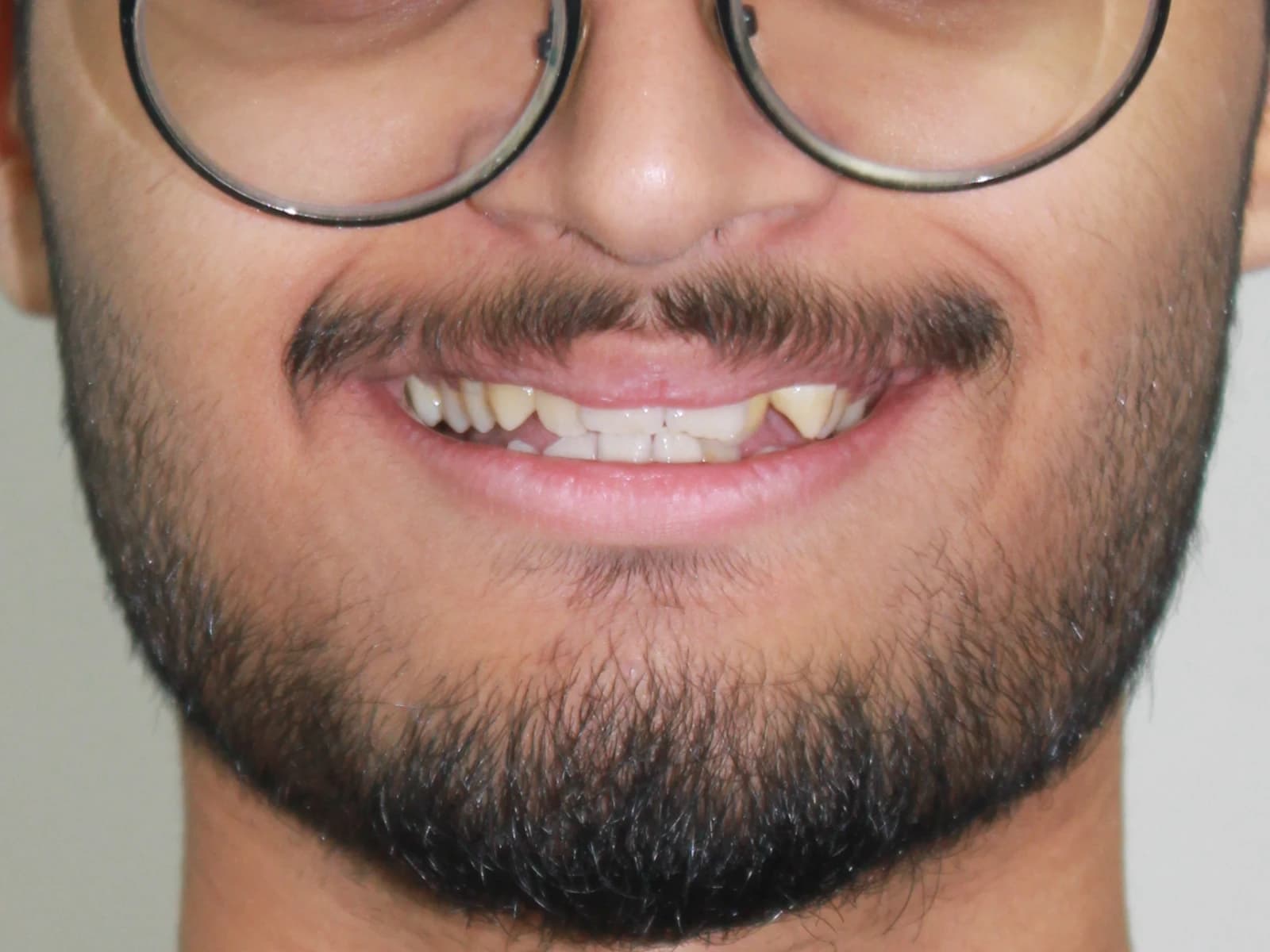 Orthodontic treatment — Before