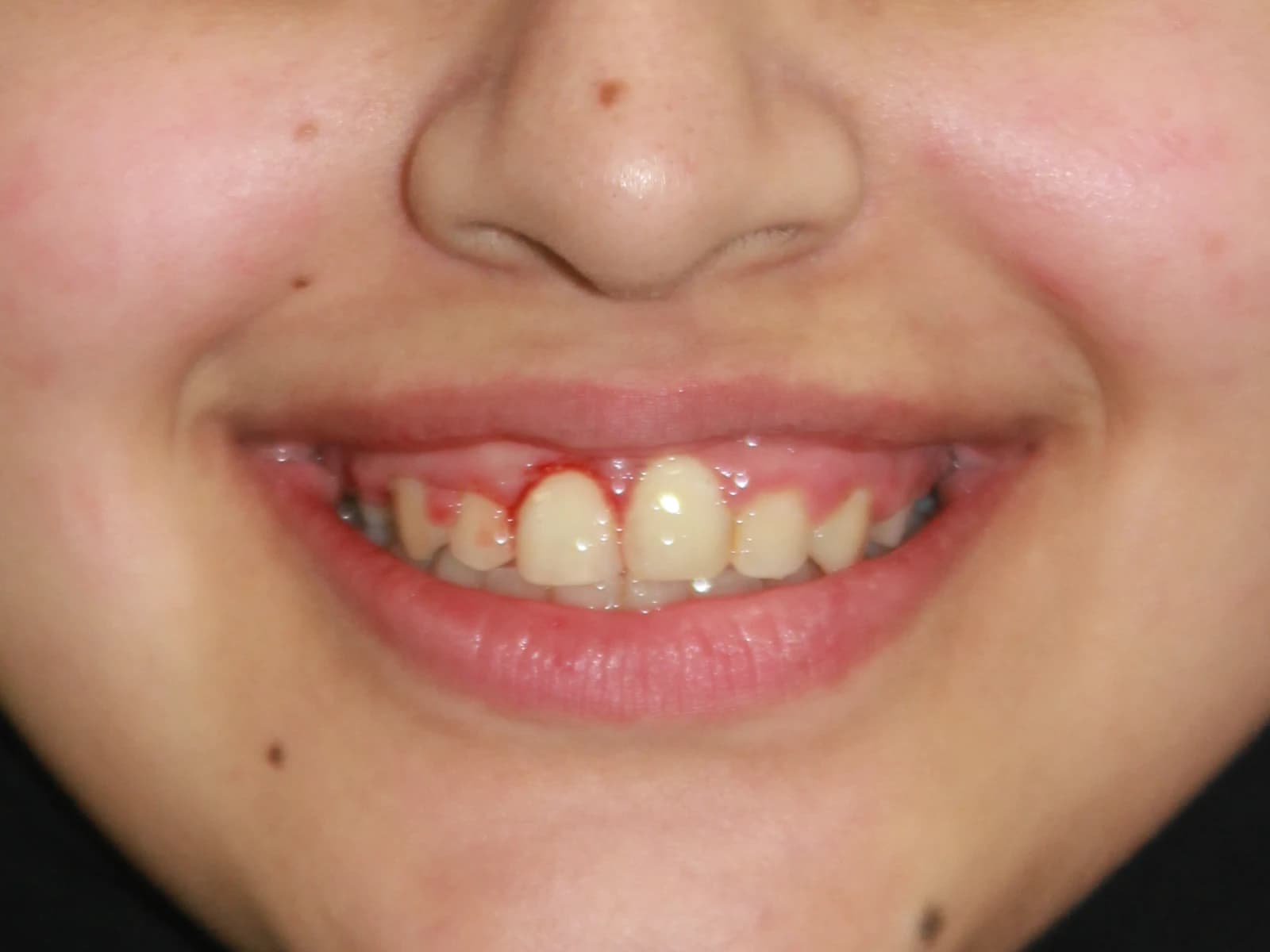 Orthodontic treatment — After