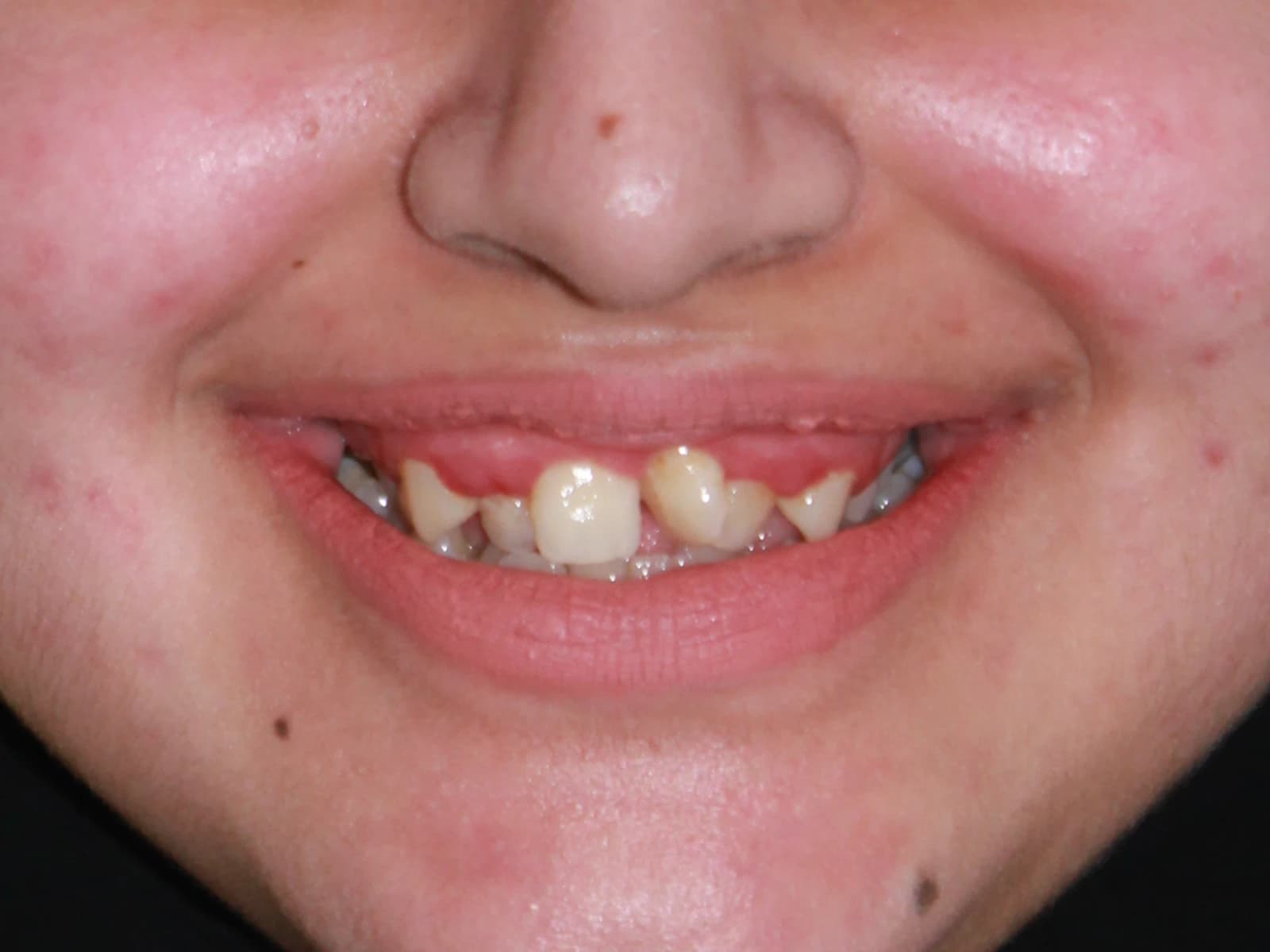 Orthodontic treatment — Before