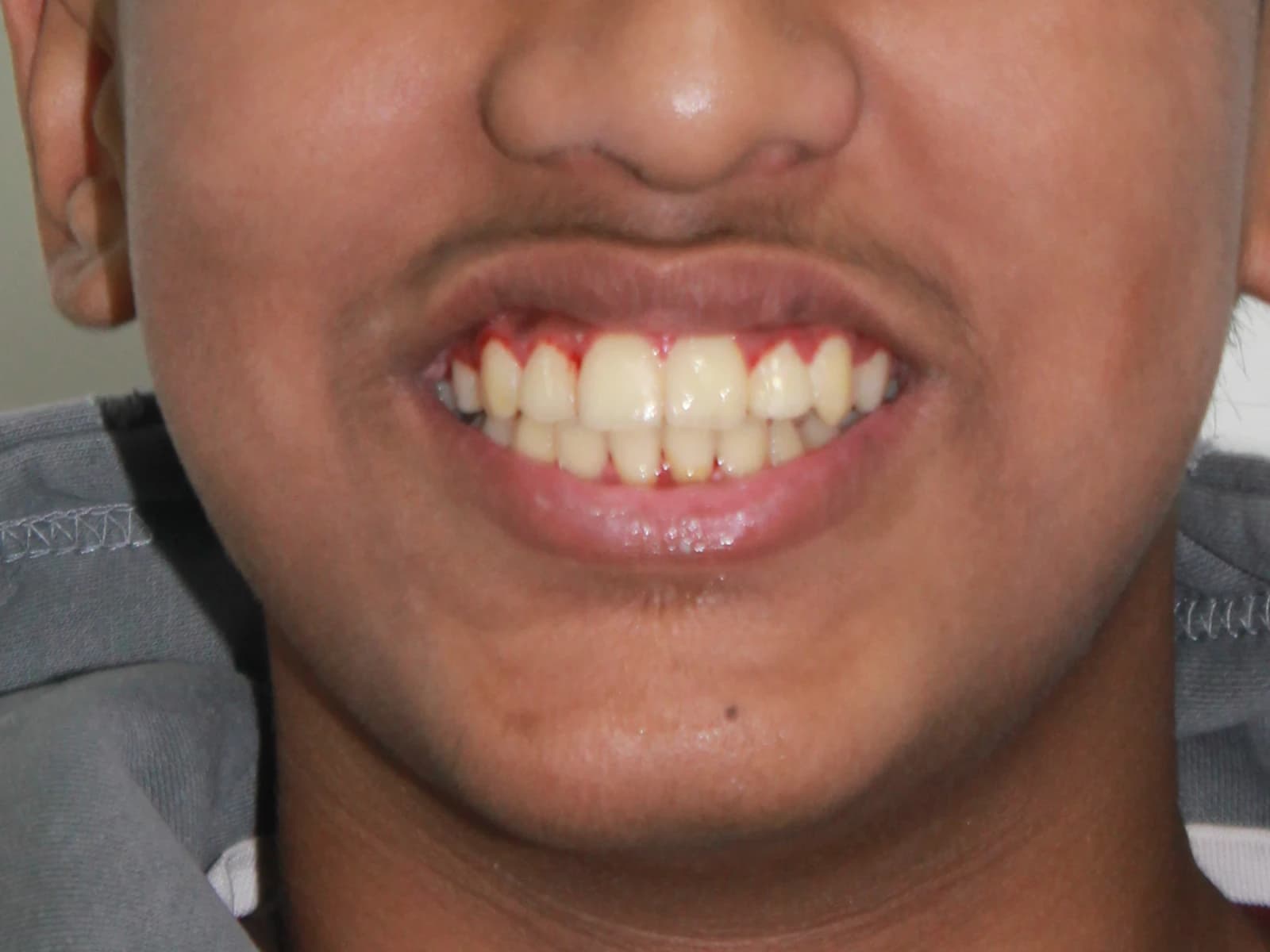 Orthodontic treatment — After