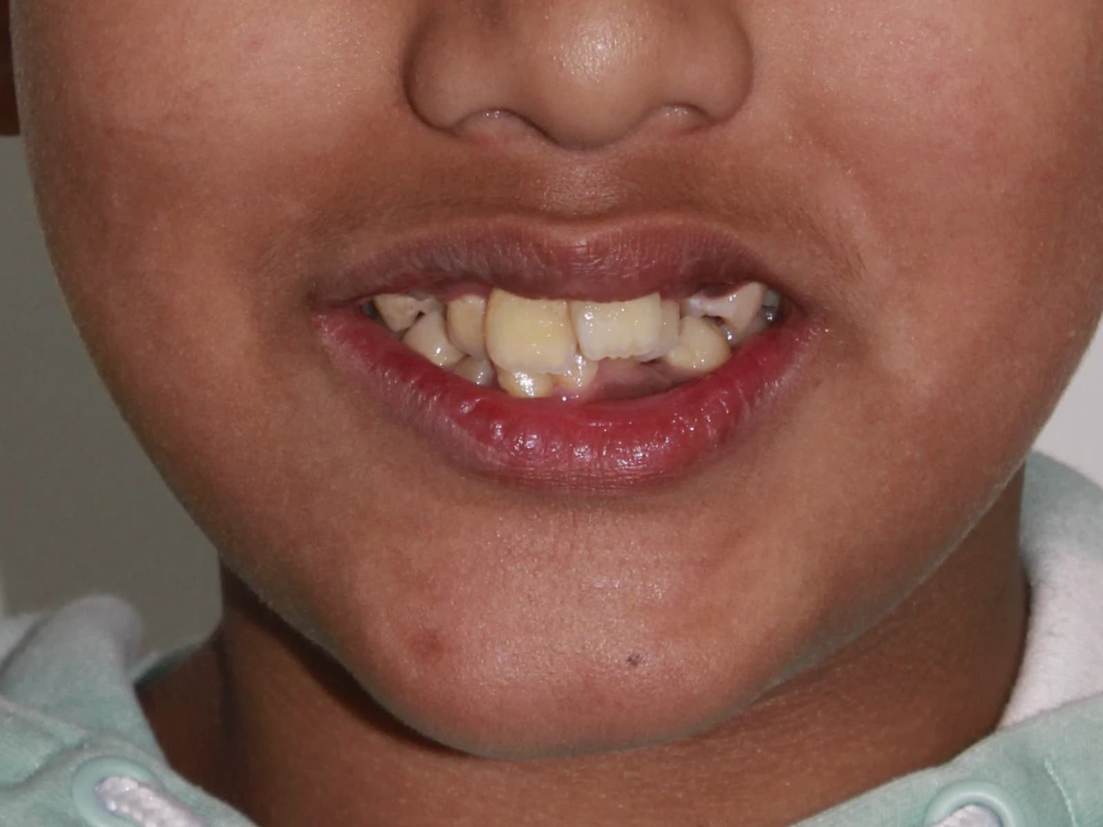 Orthodontic treatment — Before