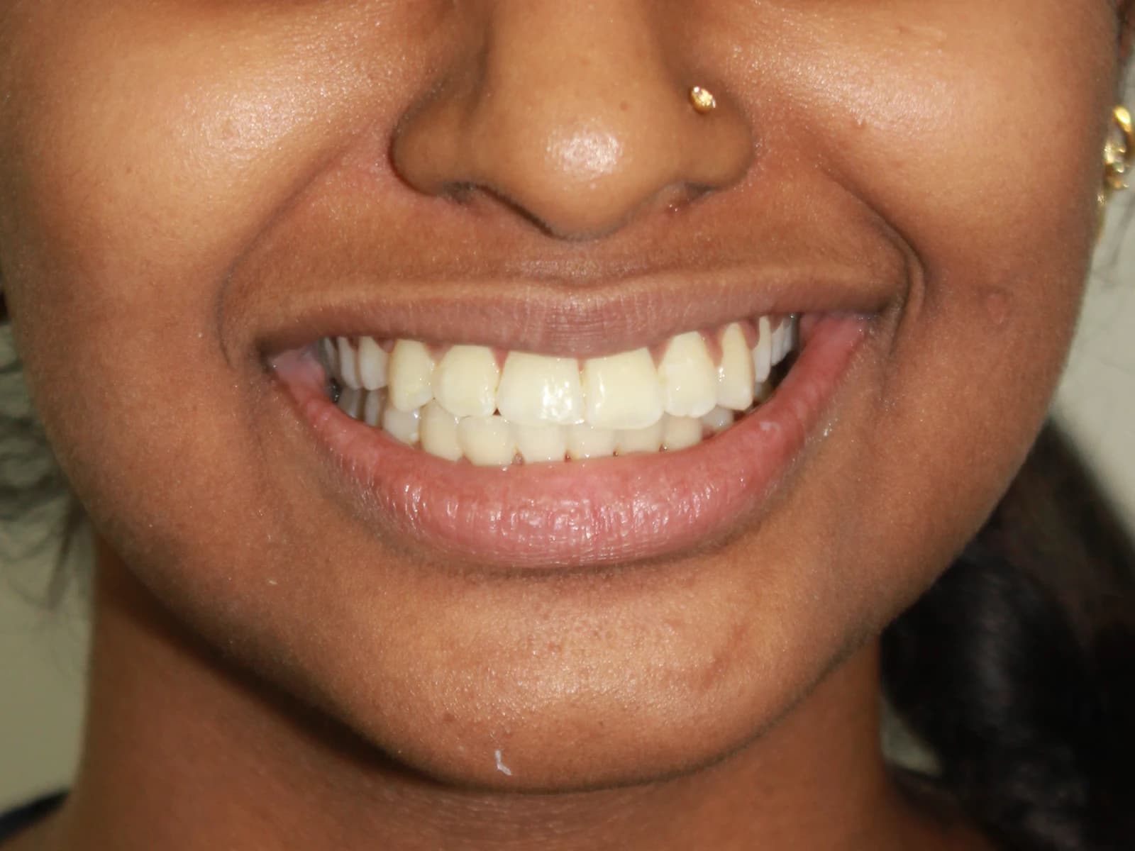 Orthodontic treatment — After