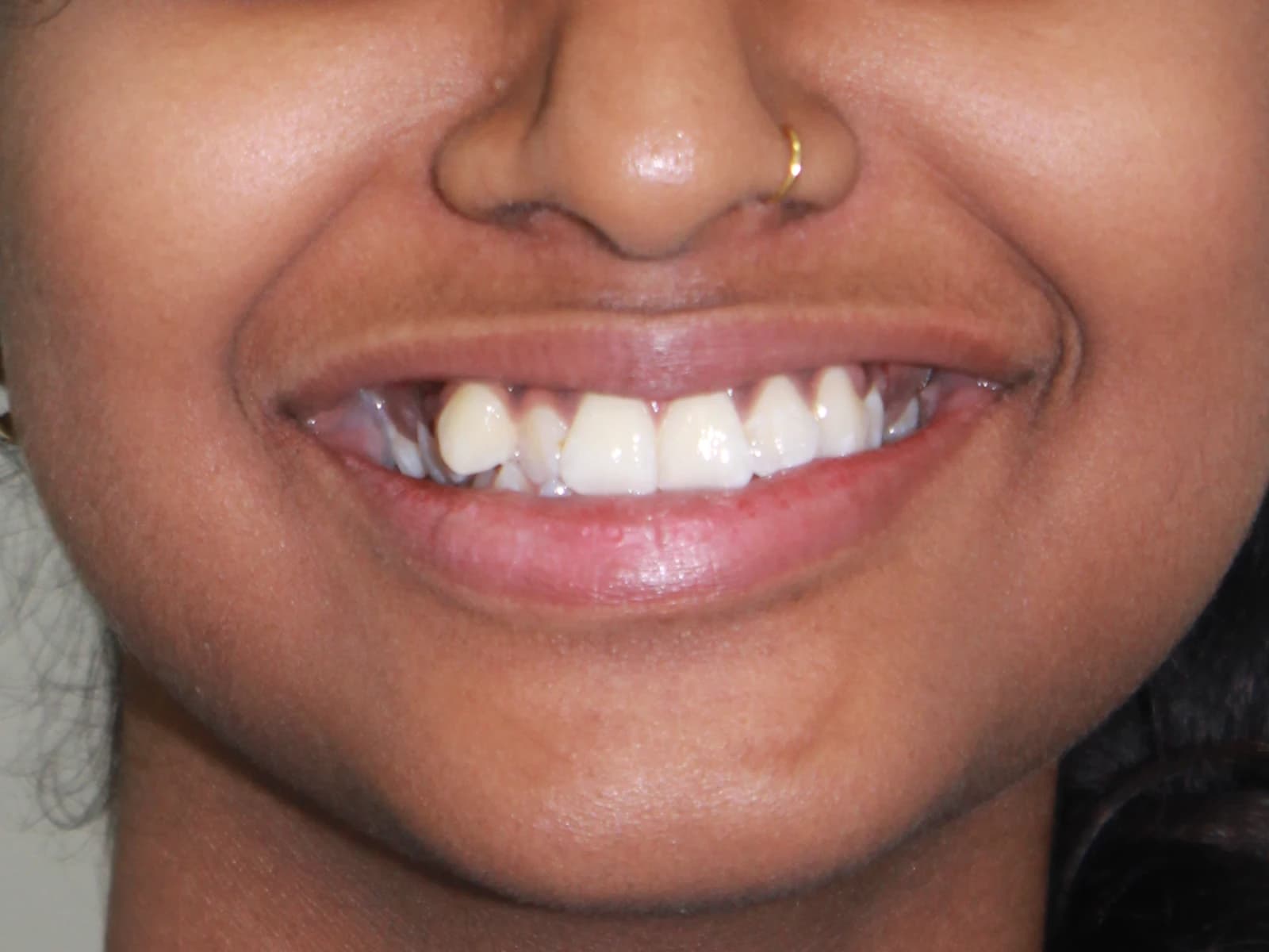 Orthodontic treatment — Before