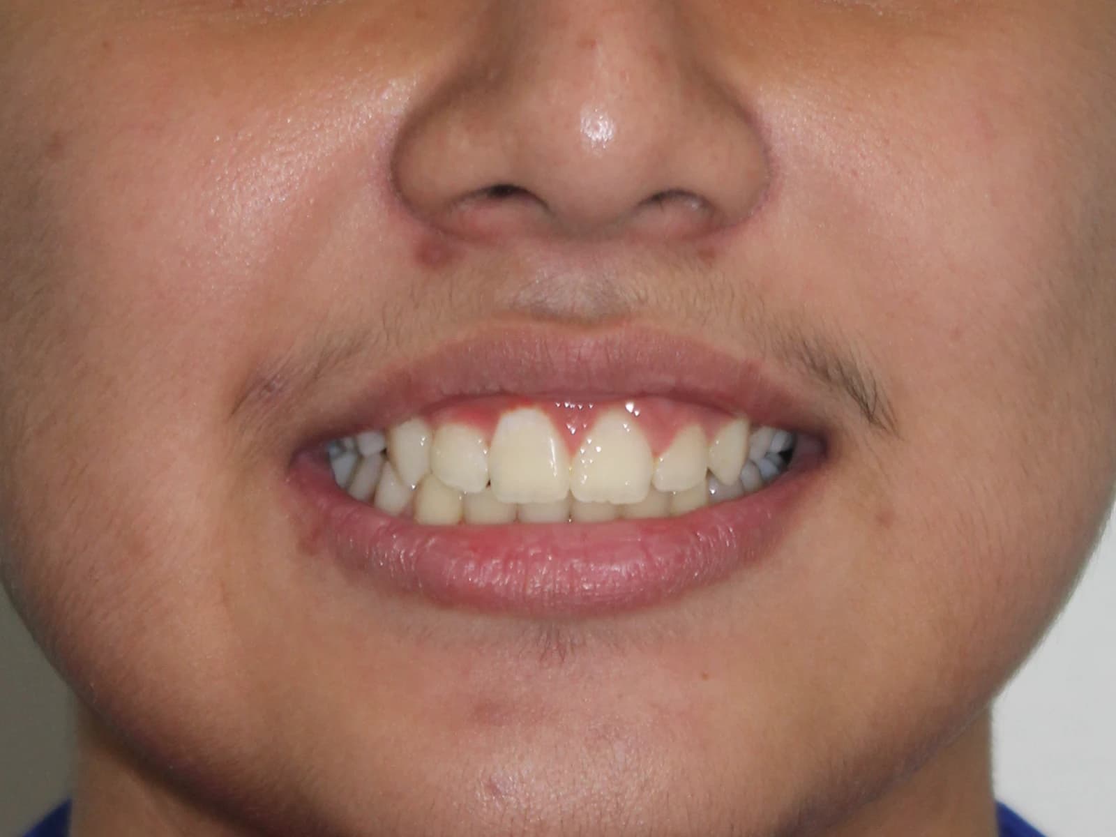 Orthodontic treatment — After