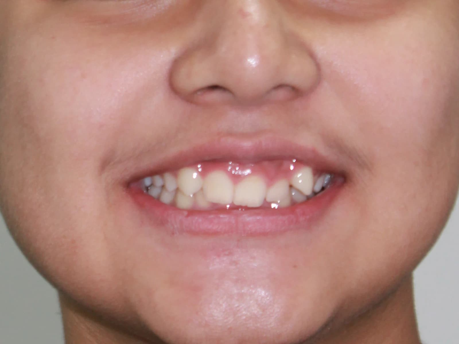 Orthodontic treatment — Before