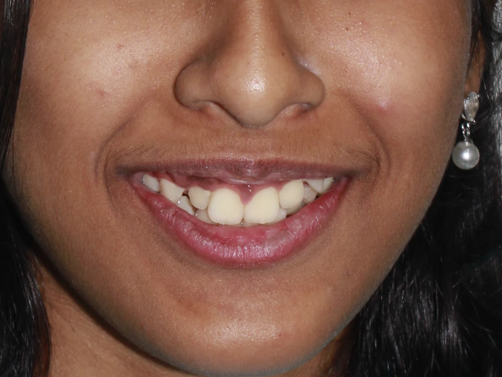 Misalignment — Before