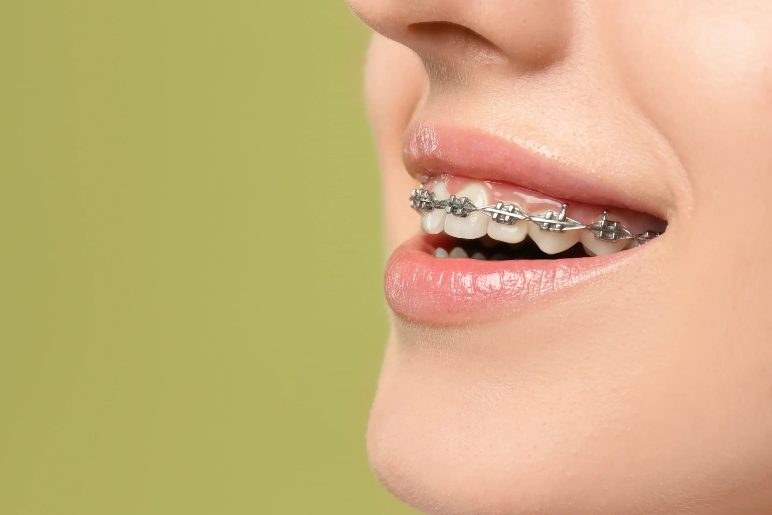Braces
